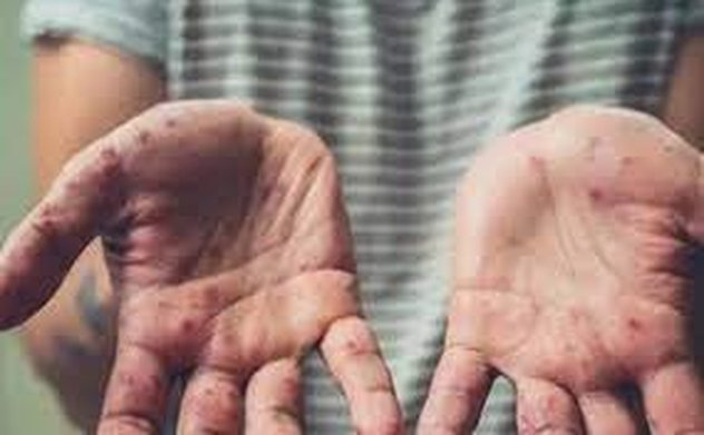 Bộ Y tế đề nghị tăng cường giám sát người đến từ 12 quốc gia lưu hành ca bệnh đậu mùa khỉ