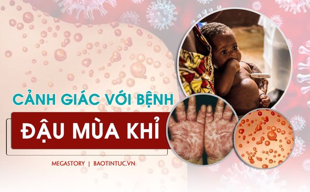 Diễn biến bệnh đậu mùa khỉ: Liệu kịch bản tương tự như COVID-19 có lặp lại?