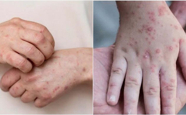 Việt Nam ghi nhận 56 trường hợp nhiễm đậu mùa khỉ, Bộ Y tế cảnh báo mầm bệnh đã xâm nhập trong cộng đồng