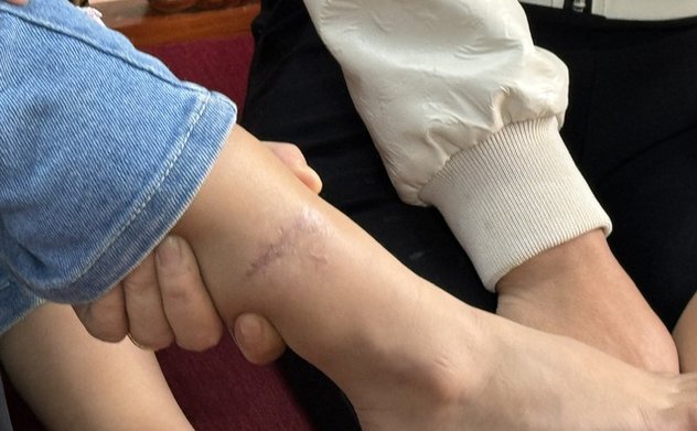 Không chủ quan với bệnh dại