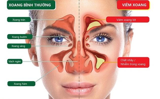 Trời mưa nồm ẩm, cảnh giác với viêm mũi xoang do nấm