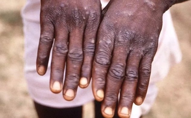 WHO khởi động chiến dịch toàn cầu ứng phó với đậu mùa khỉ 